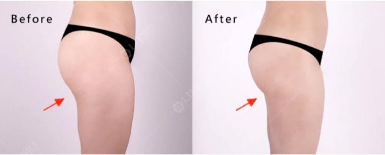 顯微套管抽脂手術案例