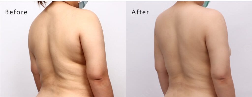 手臂抽脂價格、手臂抽脂心得、台北手臂抽脂