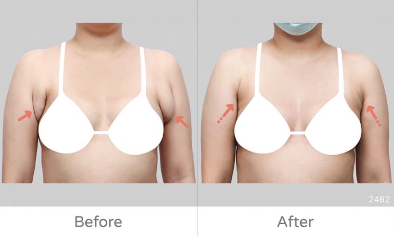 顯微套管抽脂處理腋下副乳，無須切皮傷口小，副乳案例圖