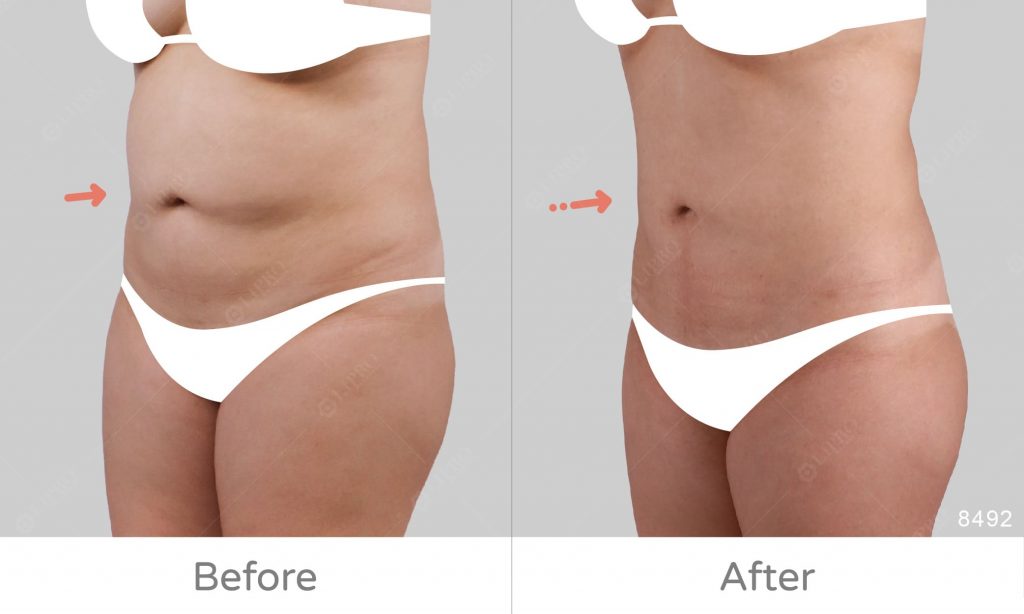 上下腹抽脂手術案例前後對照，腹部曲線修飾、傷口隱痕恢復快，不須穿塑身衣