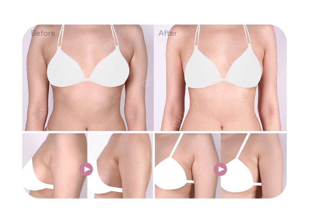 麗波副乳抽脂案例，手臂副乳修飾曲線平順