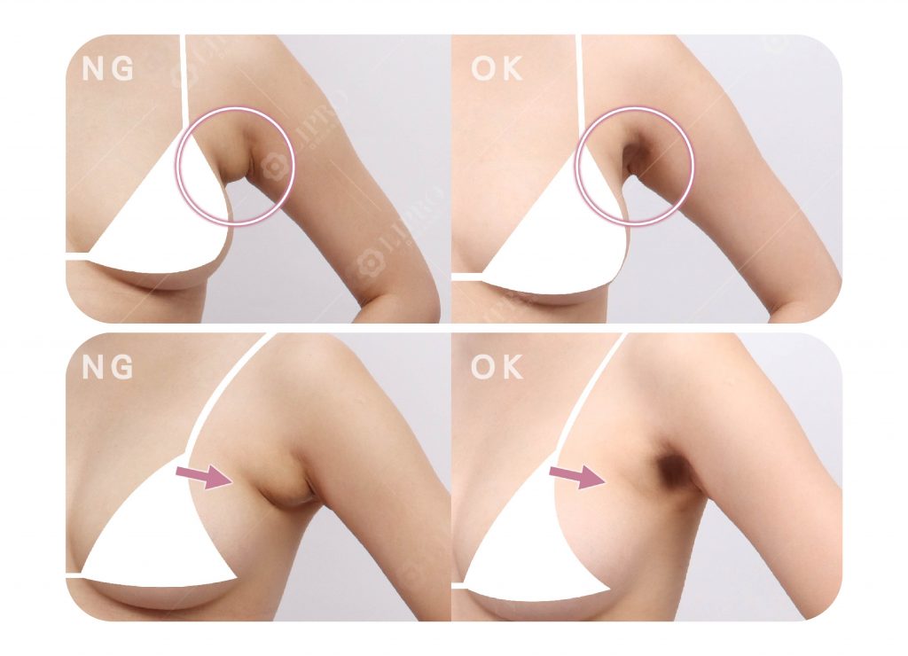 麗波副乳案例分享，副乳消除手術案例前後對比圖