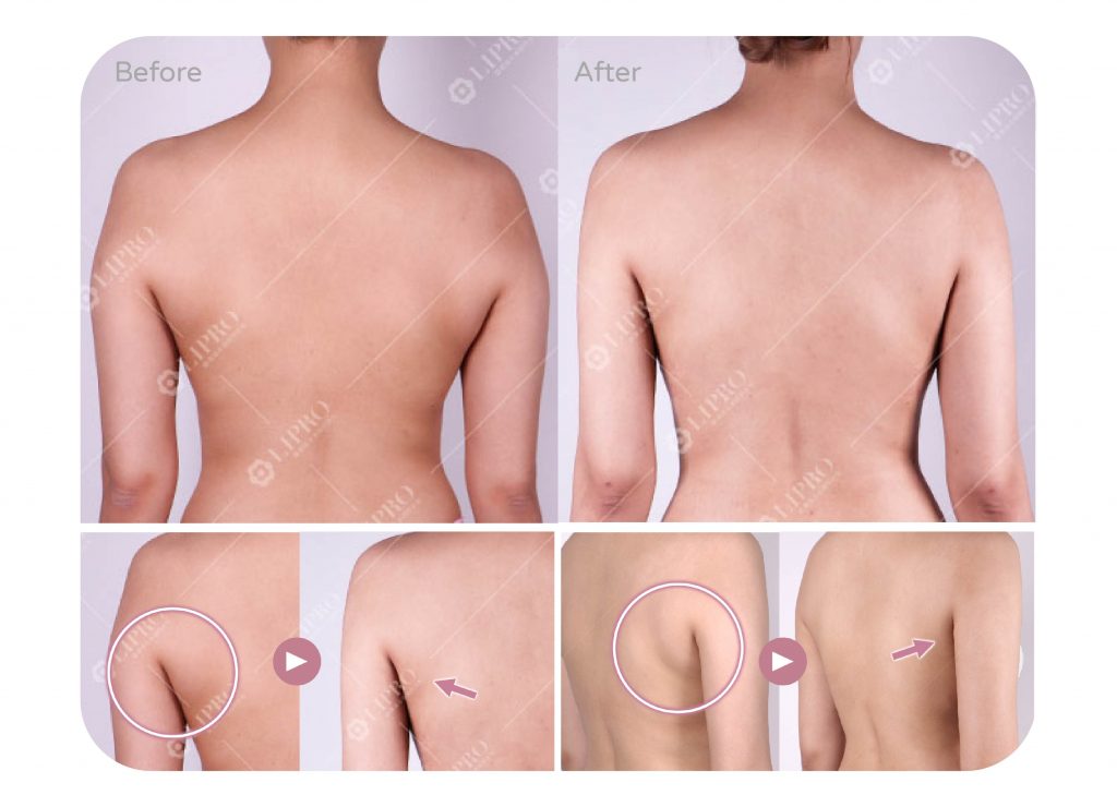 顯微套管抽脂背部曲線修飾案例成果展示