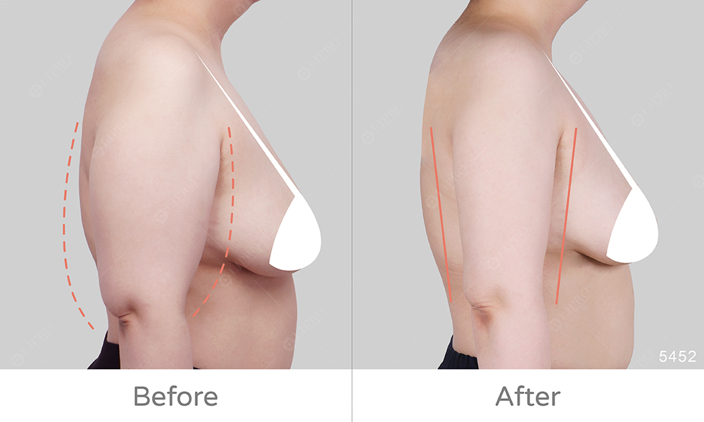 麗波手臂精緻抽脂，術後皮膚自然回彈，不需要穿塑身衣的手臂抽脂