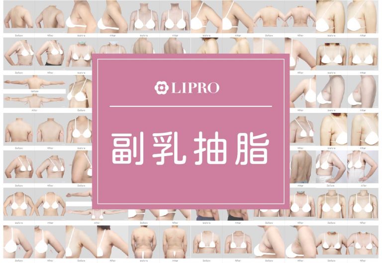 麗波永康清醒手術安全抽脂、傷口隱痕恢復快速、副乳抽脂見證圖