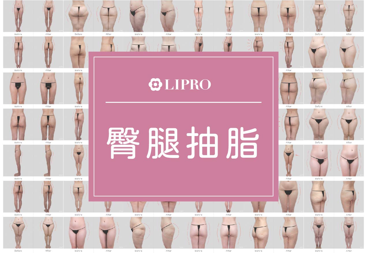 顯微套管抽脂不用穿塑身衣、可清醒手術、臀腿抽脂好評見證