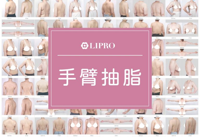 麗波永康好評、精緻抽脂手臂抽脂見證，豐富案例經驗、曲線平順自然