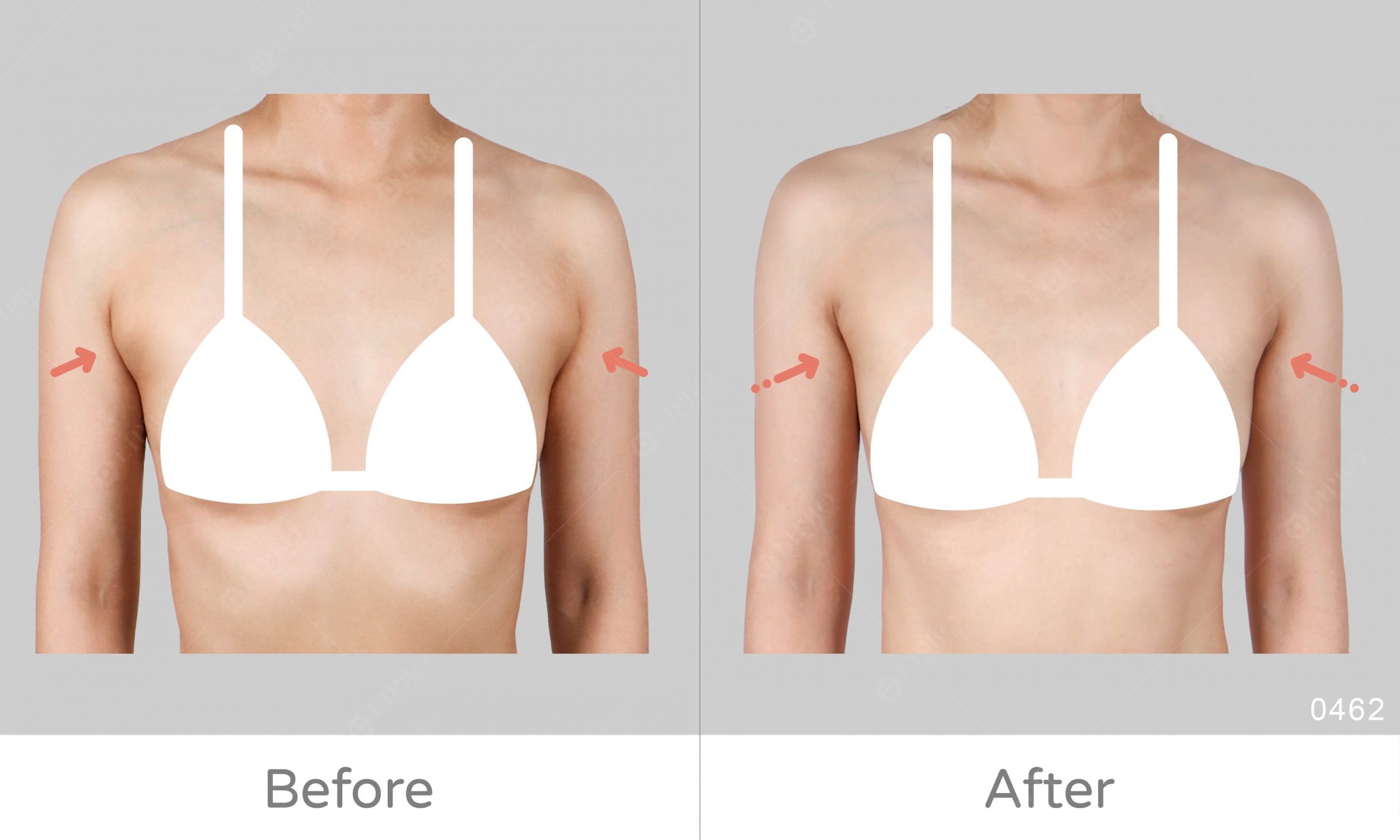 副乳抽脂案例見證，顯微套管抽脂擺脫副乳困擾