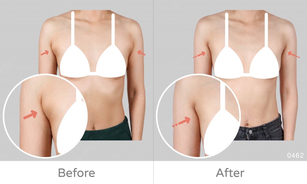 副乳精緻抽脂案例見證，抽脂手術前後改變看得見