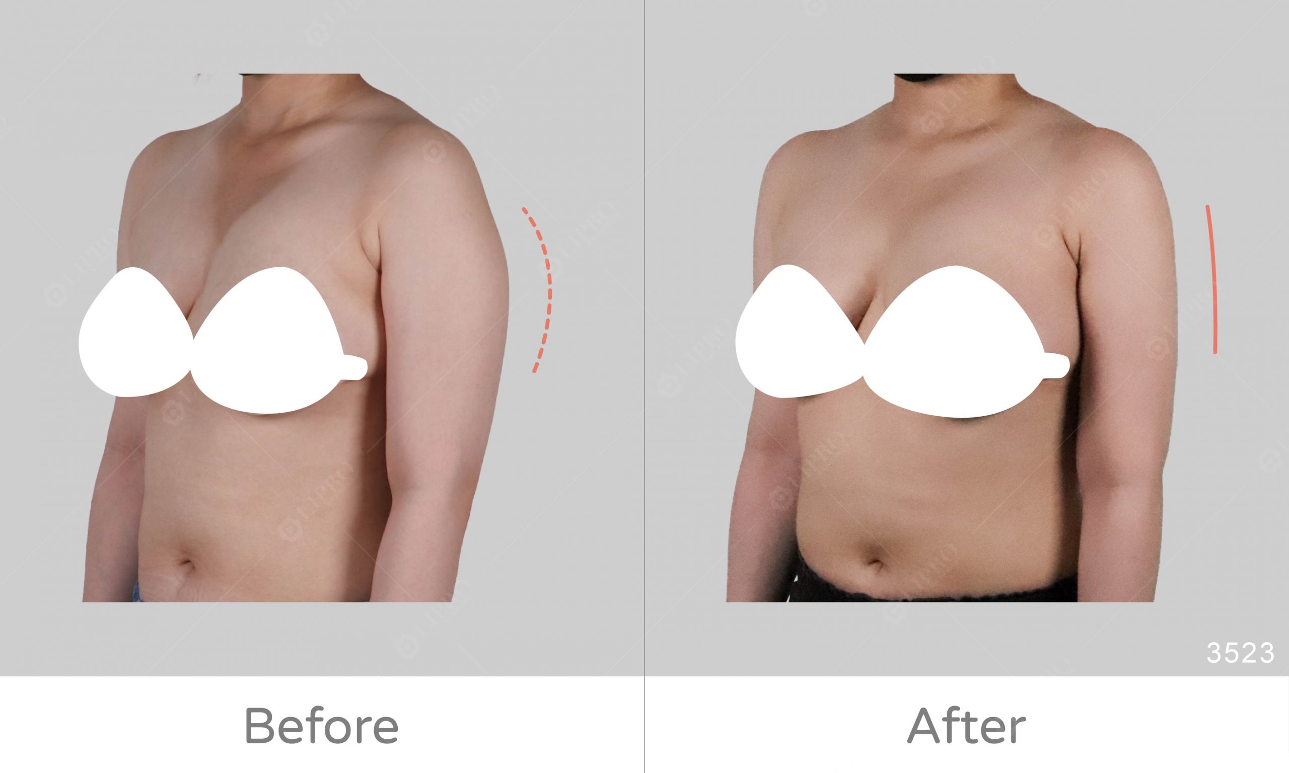 麗波手臂抽脂案例比對，可清醒手術的抽脂方式更安全放心