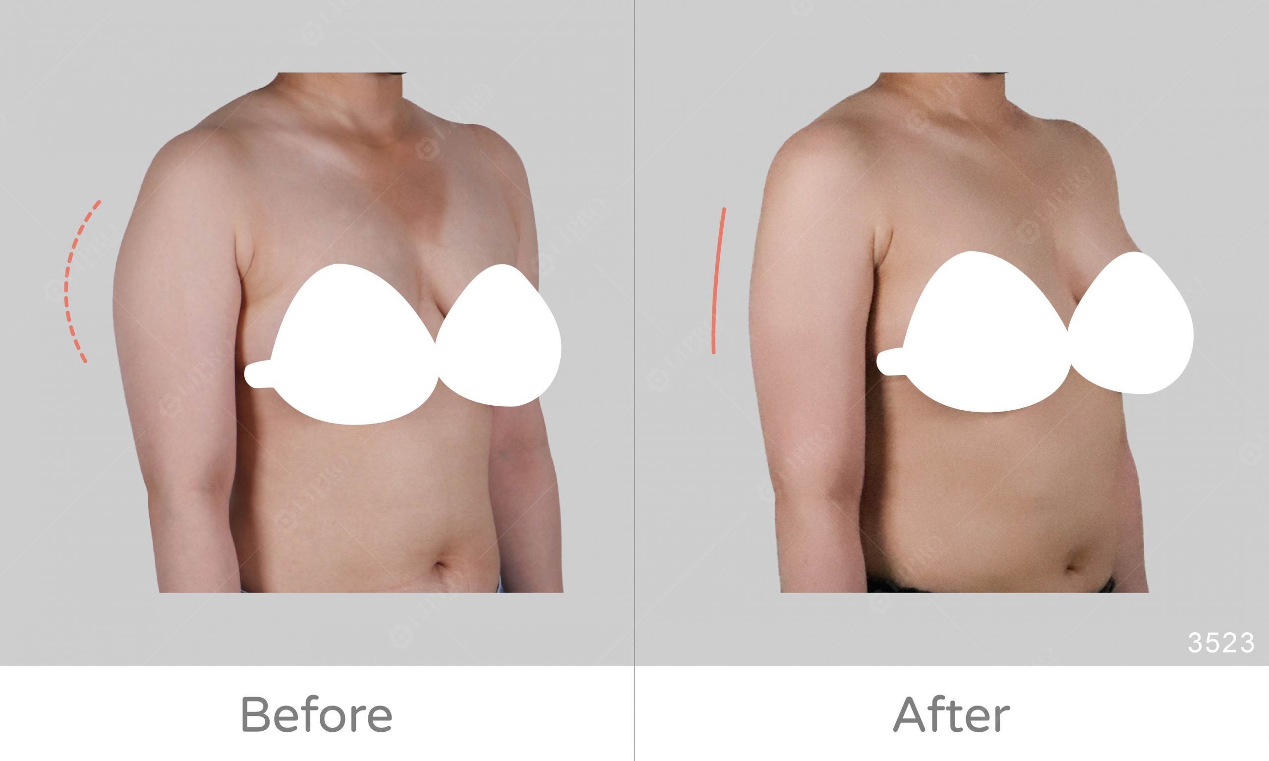 手臂抽脂術後成果，顯微套管抽脂精緻修飾上半身手臂曲線