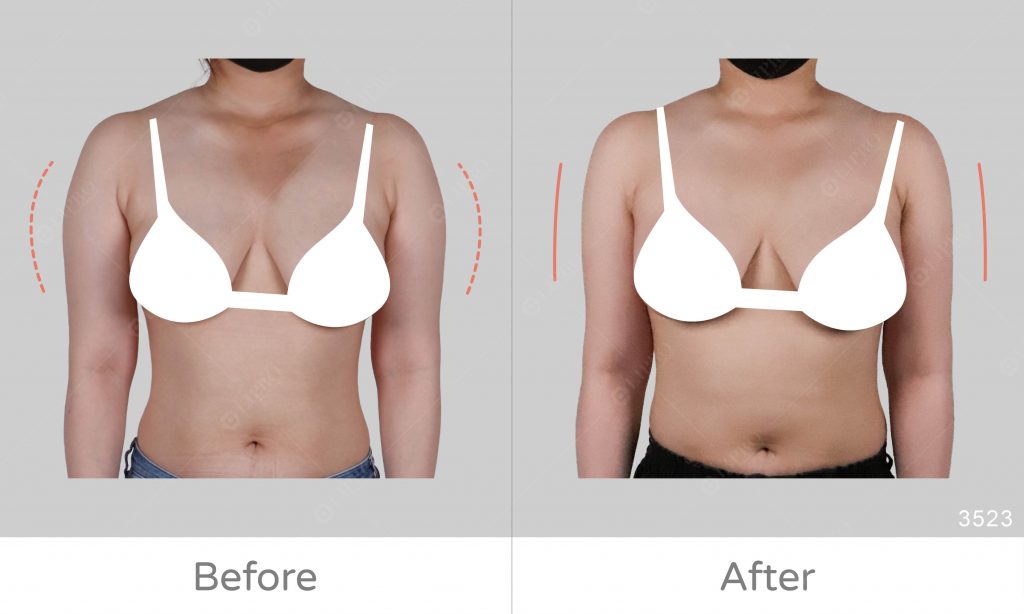 手臂抽脂的前後比對圖，上半身壯碩的視覺感減少了許多