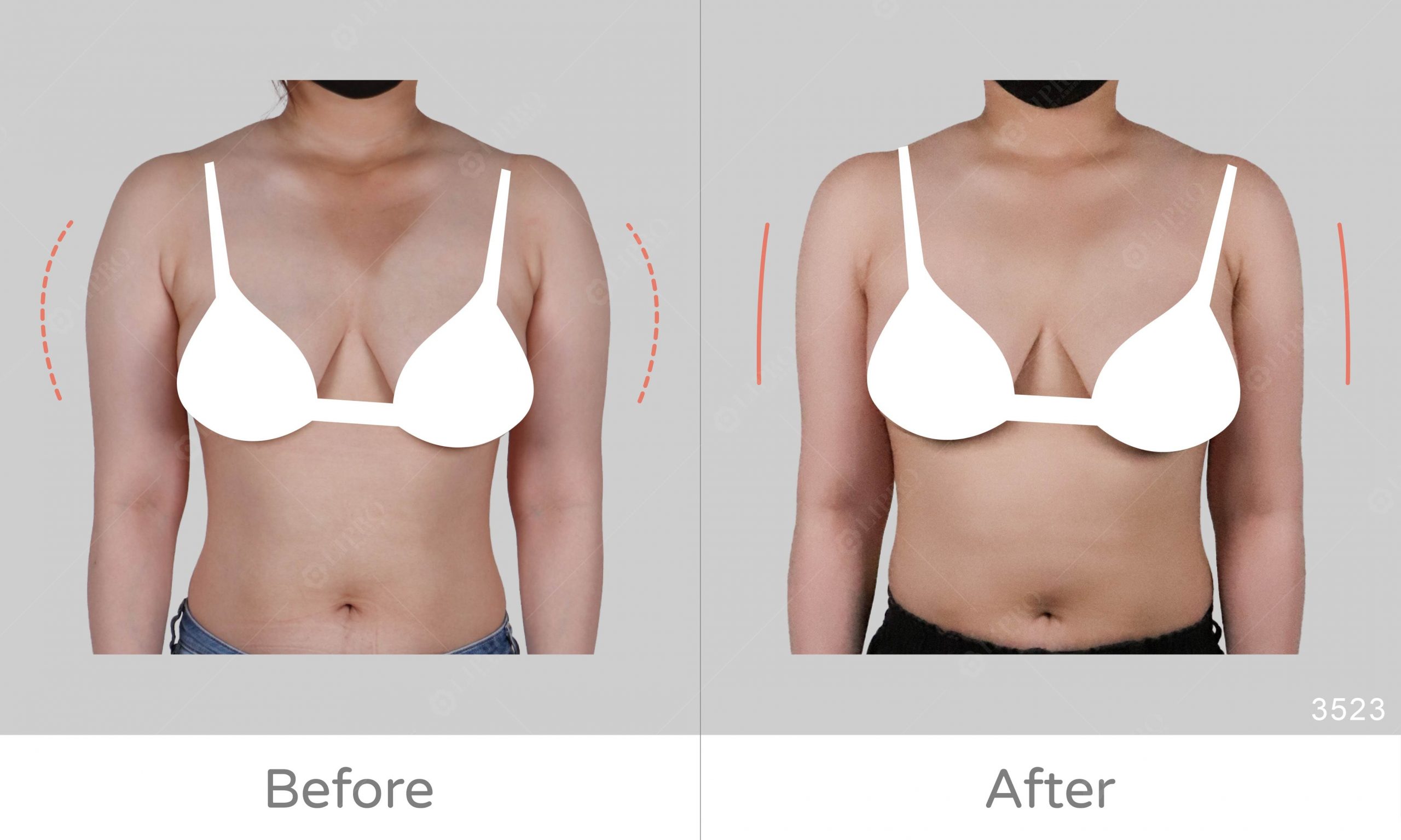 手臂抽脂的前後比對圖，上半身壯碩的視覺感減少了許多