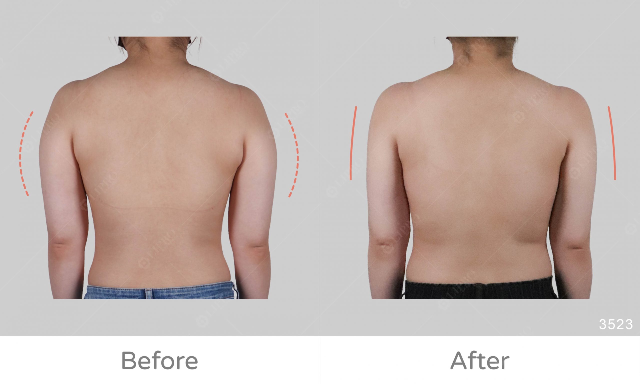 手臂抽脂術後成效零修圖真實呈現，可選擇清醒手術的抽脂方式