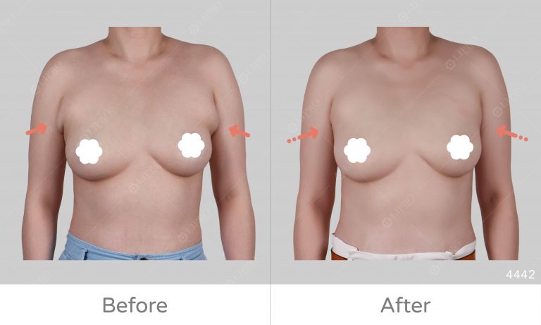 副乳抽脂取乳腺一次解決，麗波永康副乳案例成效明顯