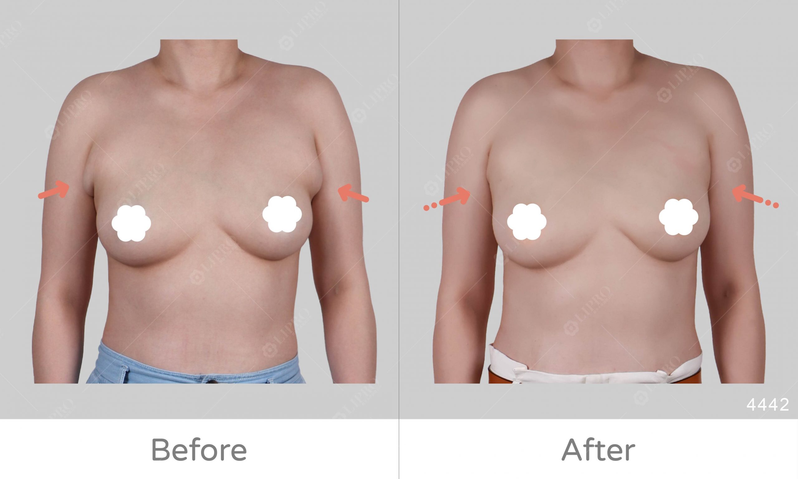 副乳抽脂取乳腺一次解決，麗波永康副乳案例成效明顯