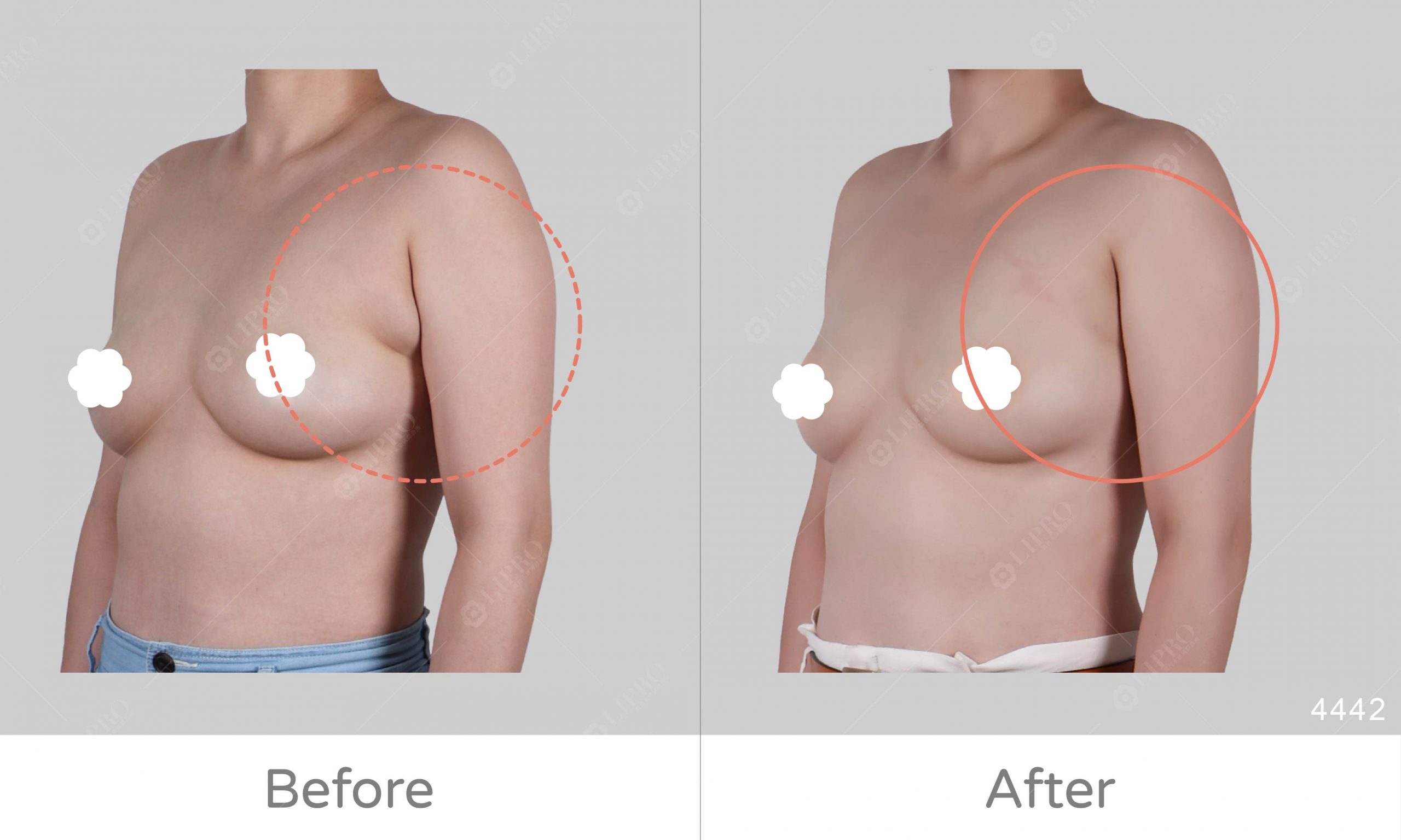 副乳類型C，副乳抽脂取乳腺一次解決，傷口隱痕快速恢復