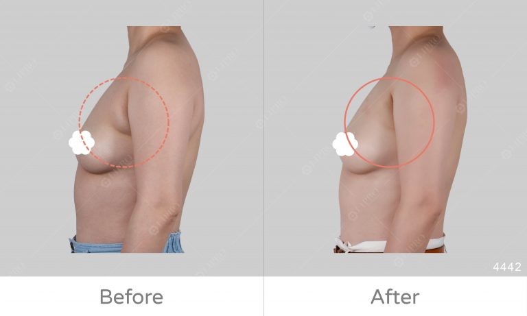 副乳消除的好選擇、顯微套管抽脂術，不須穿塑身衣，副乳抽脂成效