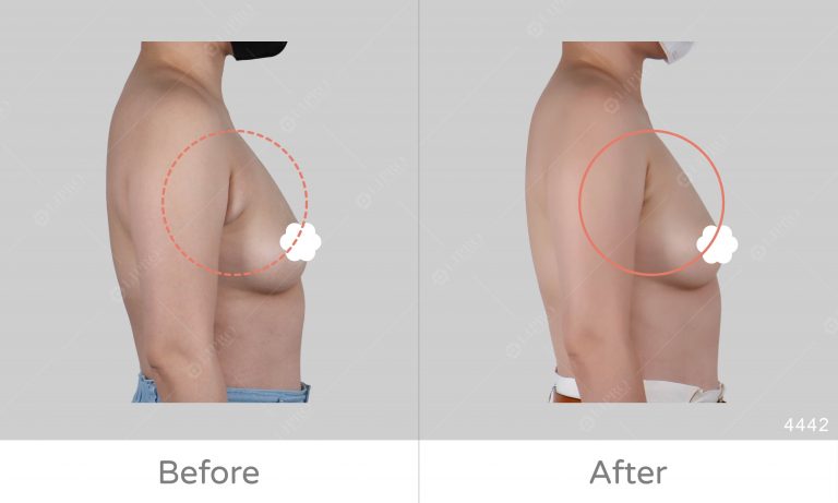 側面對比副乳抽脂案例效果，麗波有豐富副乳案例經驗
