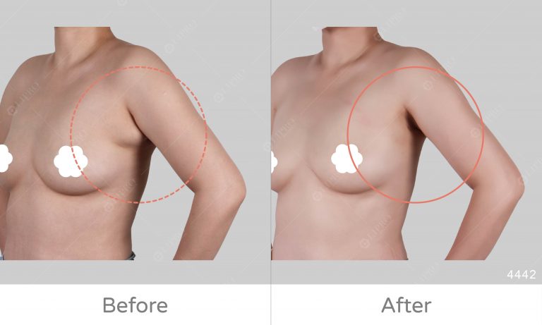 舌頭型副乳案例，副乳的案例類型分享，麗波多案例