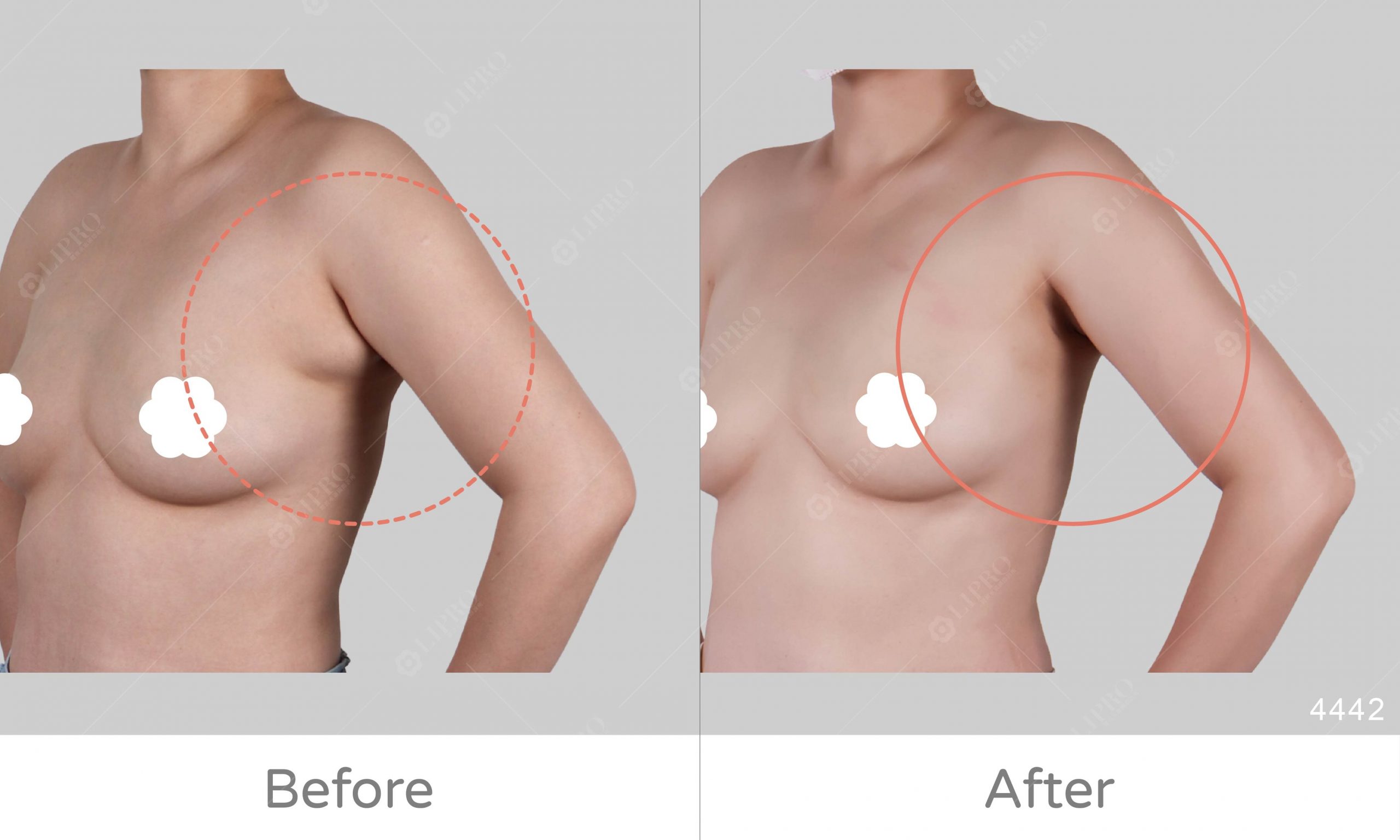 舌頭型副乳案例，副乳的案例類型分享，麗波多案例