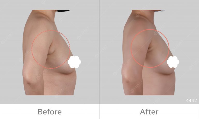 副乳消除前後對比圖，副乳抽脂案例分享