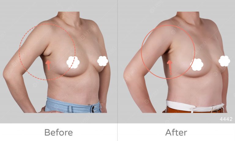 了解副乳的成因與案例類型，突出副乳案例分享，麗波豐富案例經驗