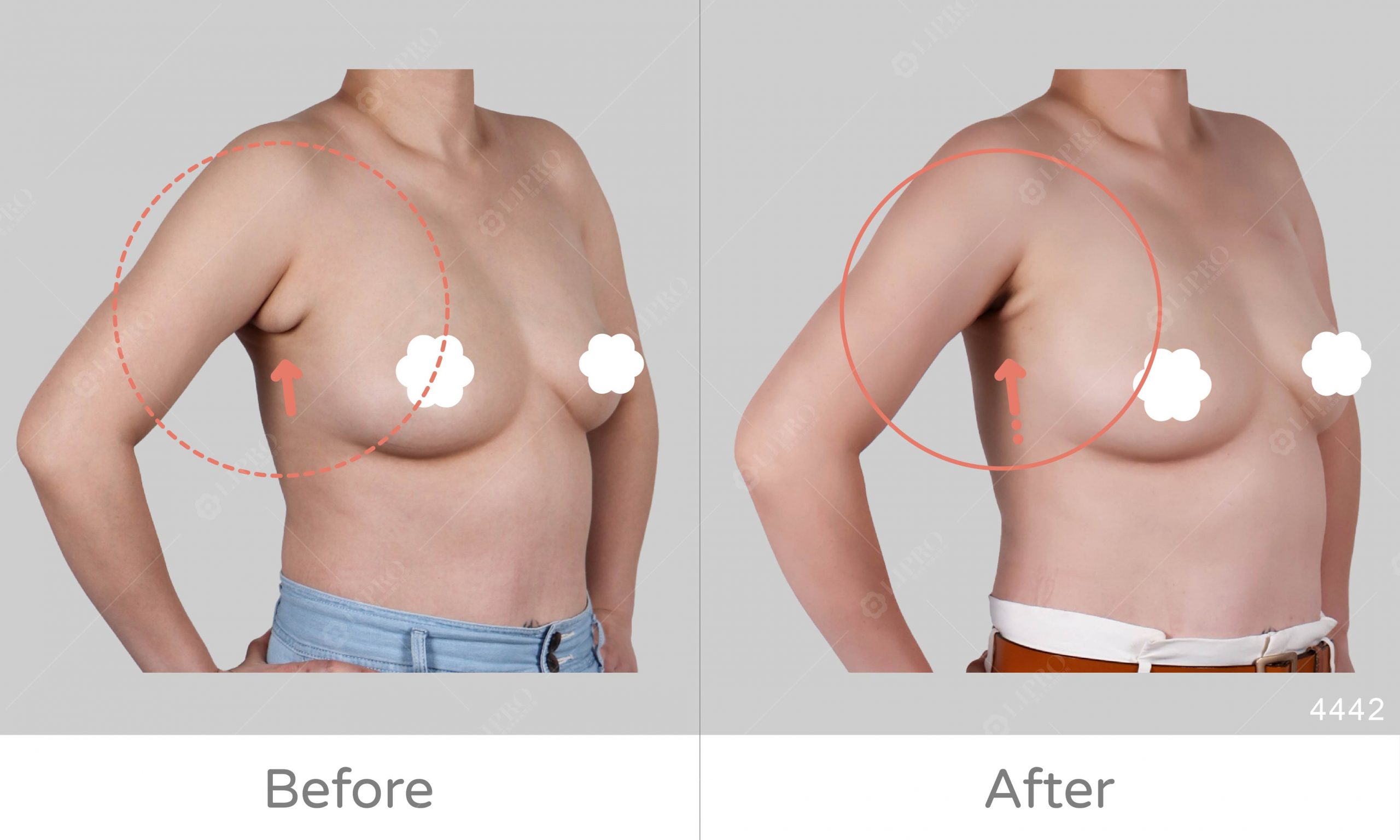 了解副乳的成因與案例類型，突出副乳案例分享，麗波豐富案例經驗