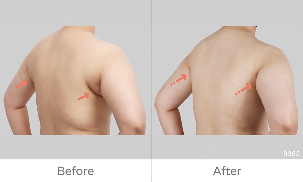 副乳手術術後成效圖片，精緻副乳抽脂，擺脫腋下摩擦困擾
