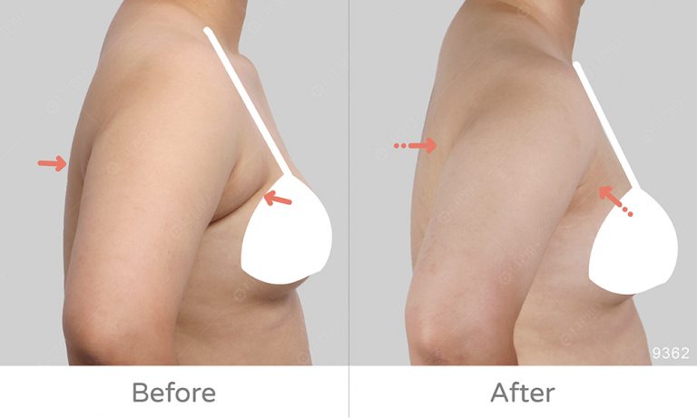 圓圓的副乳案例、不須切皮、不須塑身衣的顯微套管抽脂，副乳抽脂的好選擇