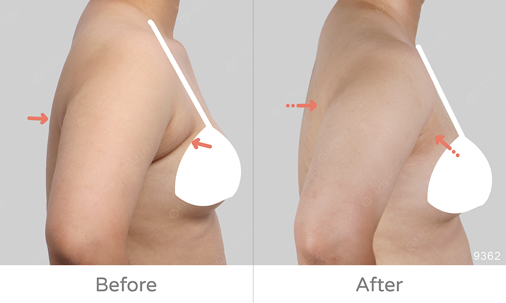 圓圓的副乳案例、不須切皮、不須塑身衣的顯微套管抽脂，副乳抽脂的好選擇