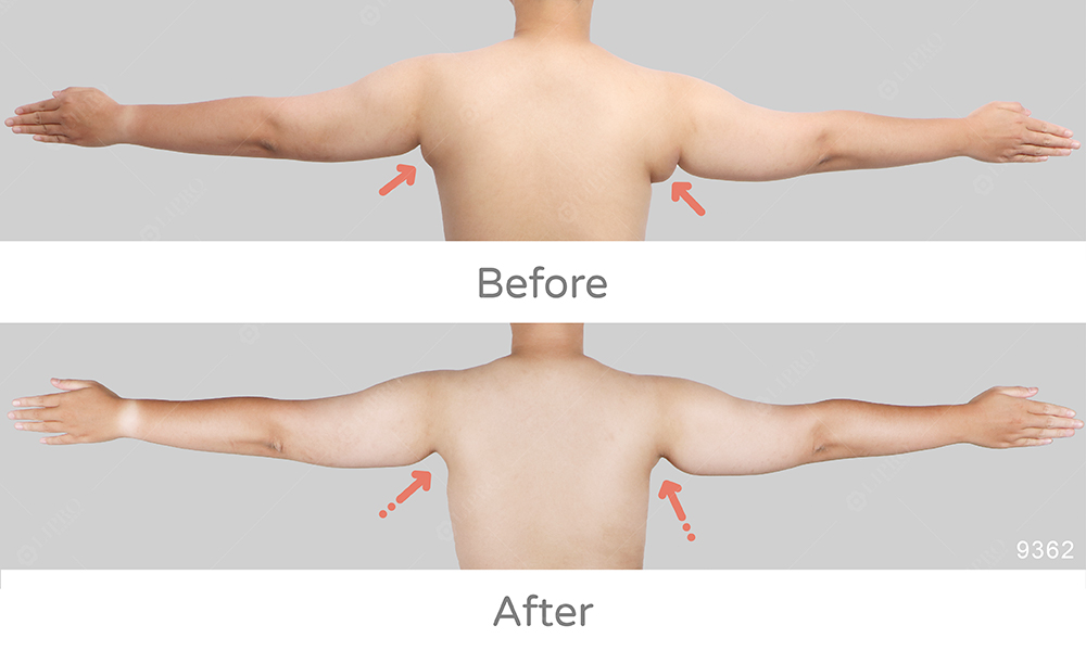 麗波副乳案例BA成果，腋下副乳問題成功解決