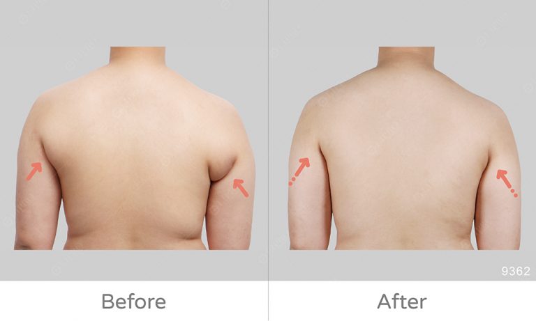 副乳改變成果滿意，麗波副乳抽脂案例分享圖示