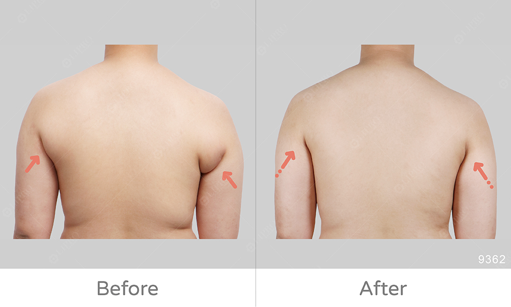 副乳改變成果滿意，麗波副乳抽脂案例分享圖示