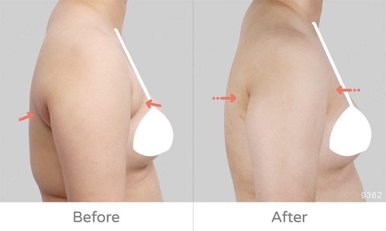 副乳類型解析、腋下副乳消除、副乳抽脂案例分享