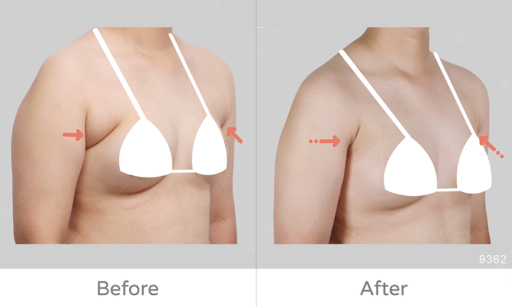 巨大副乳案例分享，擺脫副乳困擾大滿意，顯微套管抽脂特色