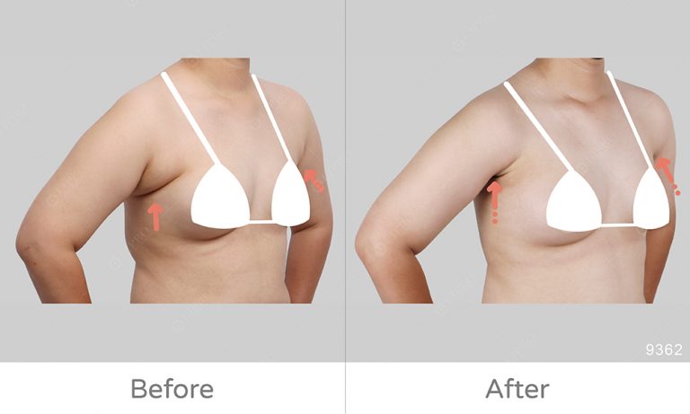 副乳類型B:圓圓的副乳，副乳抽脂案例分享