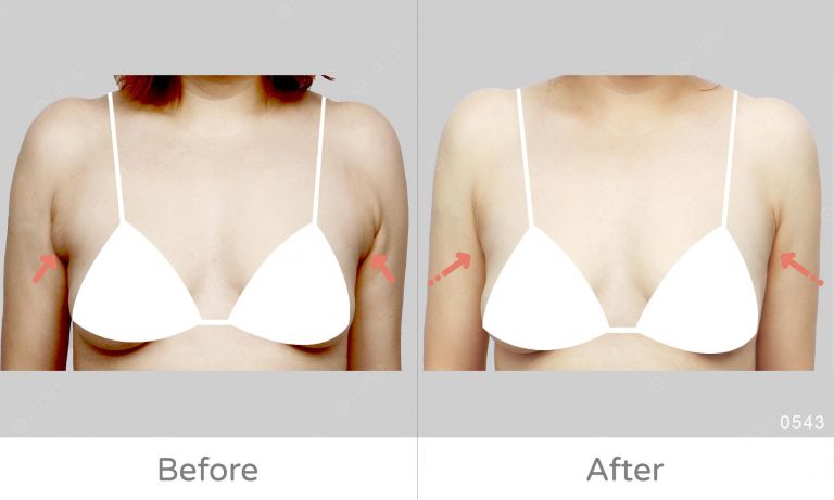 副乳二次重修滿意，重修抽脂手術經驗豐富，麗波顯微套管抽脂術