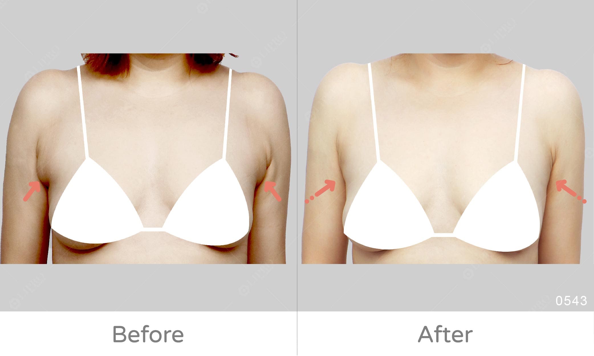 副乳二次重修滿意，重修抽脂手術經驗豐富，麗波顯微套管抽脂術