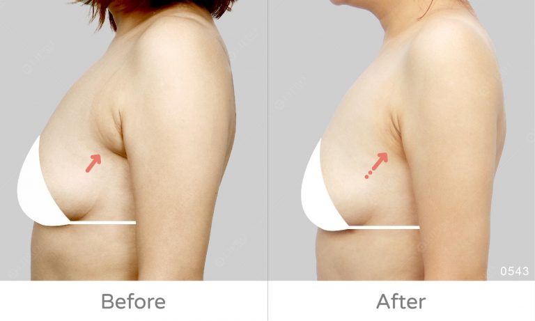 副乳二次修復案例成果見證，麗波成功修復副乳問題