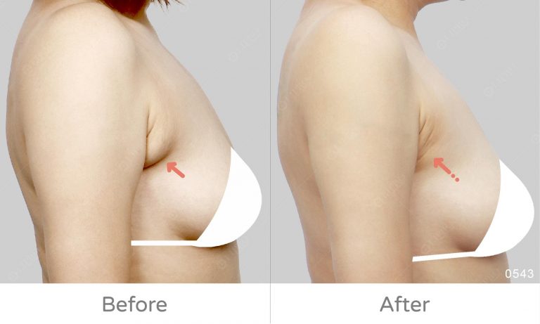 副乳重修案例，二次修復專家李咏馨醫師，細緻處理細節