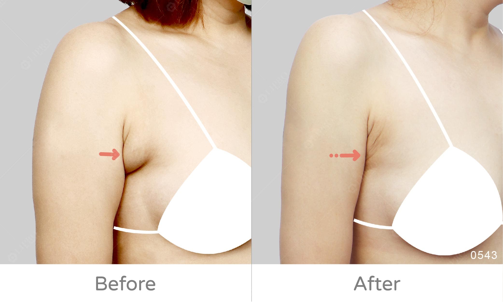 副乳二次重修案例見證，麗波重修經驗豐富，上半身曲線修飾