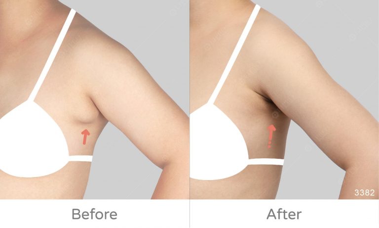 副乳大小不一的情況，麗波永康副乳案例術後成效