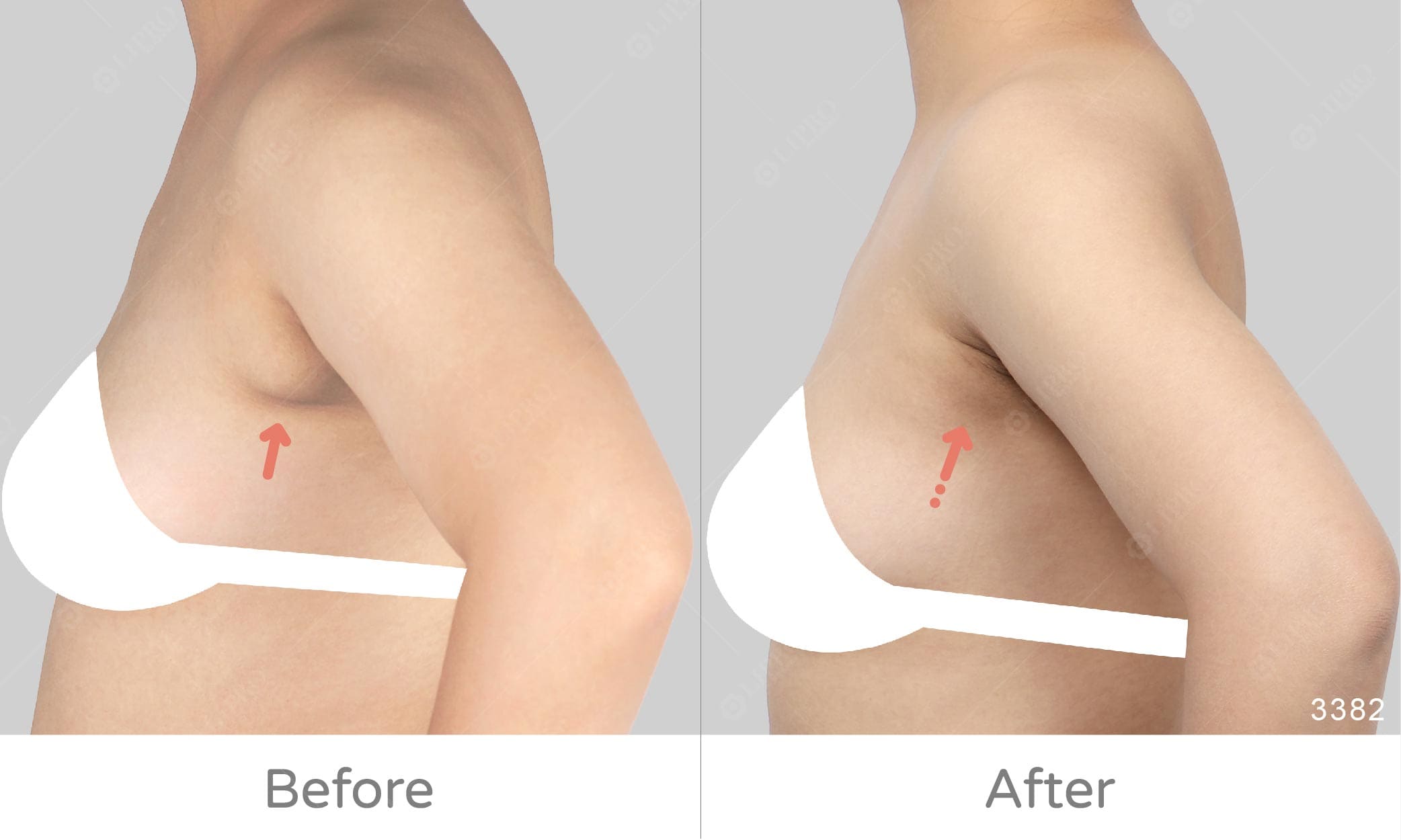 左右副乳大小不同一併處理，麗波副乳處理案例經驗眾多