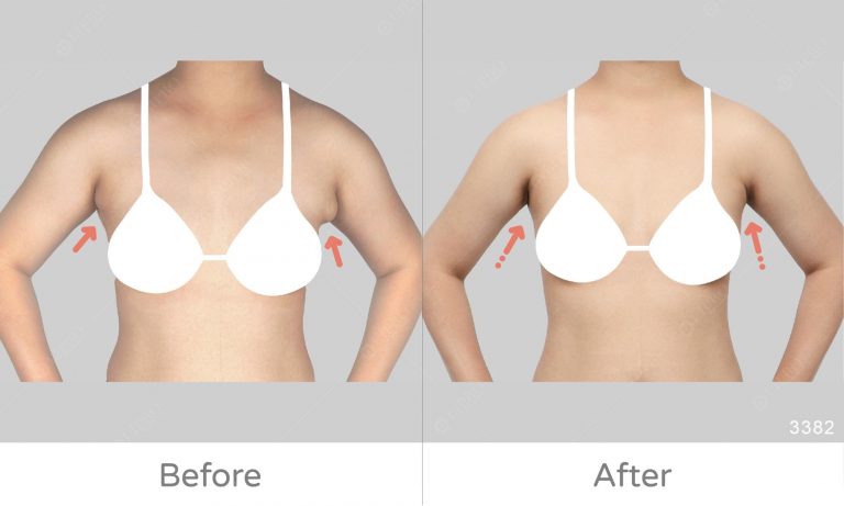 左右副乳大小不一的案例，麗波永康副乳案例成果展示