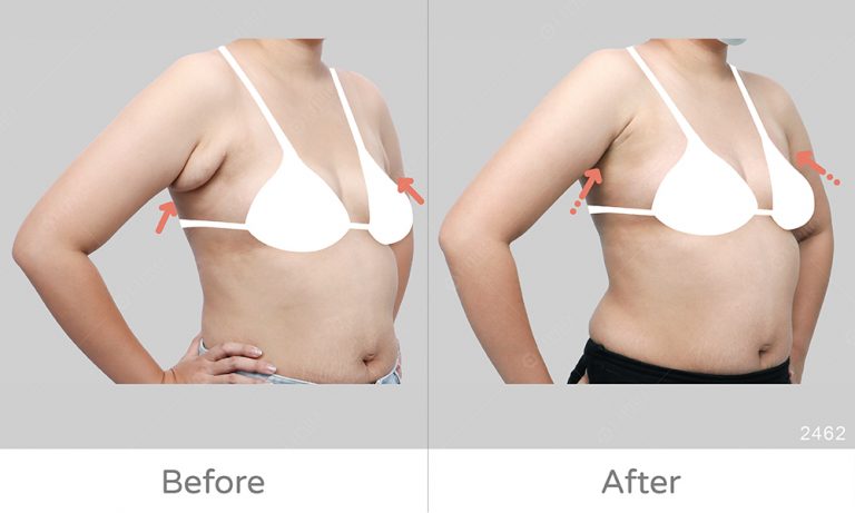 副乳困擾讓麗波幫你解決，顯微套管抽脂優勢:不須穿塑身衣、可清醒麻醉更安全