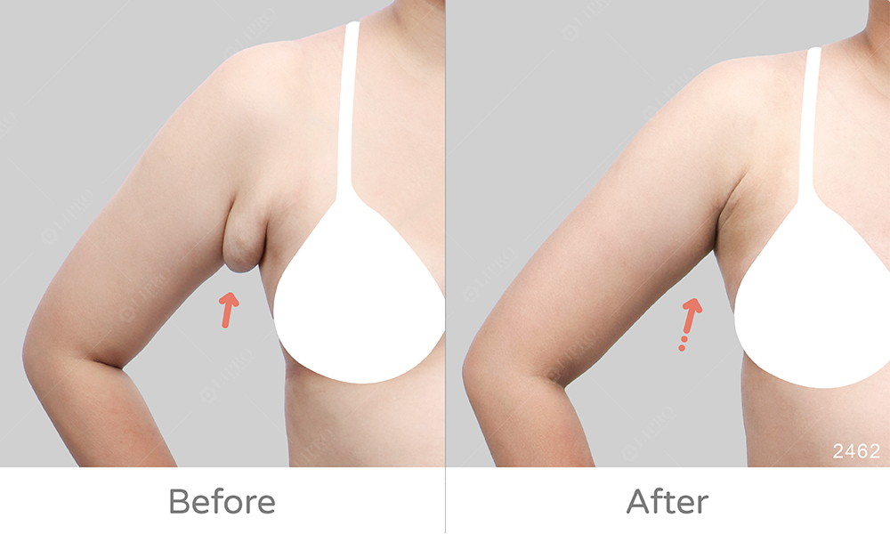 顯微套管抽脂處理擴散型副乳，了解副乳成因、類型與改善方式