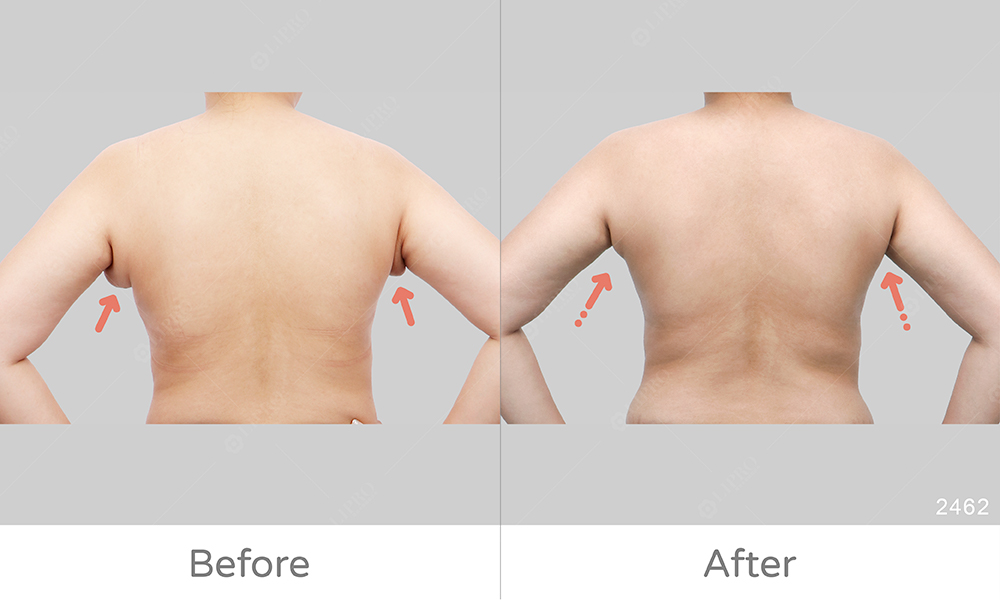 顯微套管抽脂解決副乳摩擦困擾，腋下輕鬆無負擔