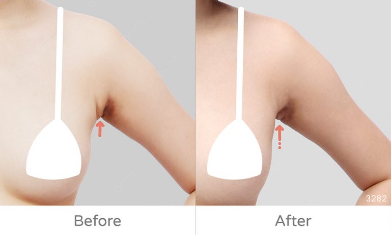 副乳二次重修個案術前術後對比，麗波二次重修專家，豐富案例經驗好評
