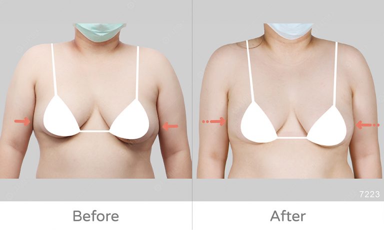 副乳太大影響手臂自然動作，麗波精緻抽脂消除副乳困擾